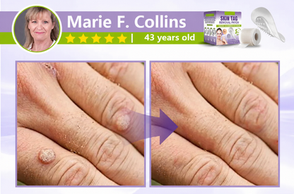 Soluble Microneedle Botanical Skin Tag Removal Patch